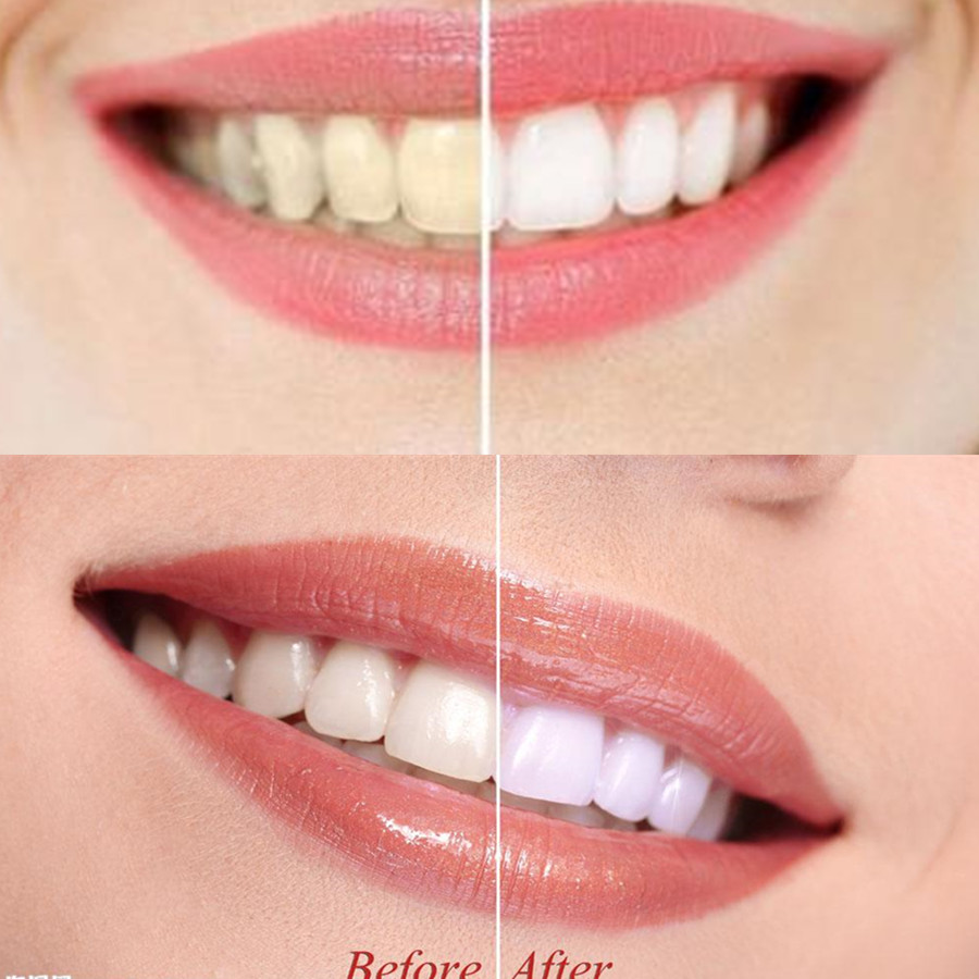 Dentes de carvão vegetal de ba - Teeth Whitening Diy avaliação e preço
