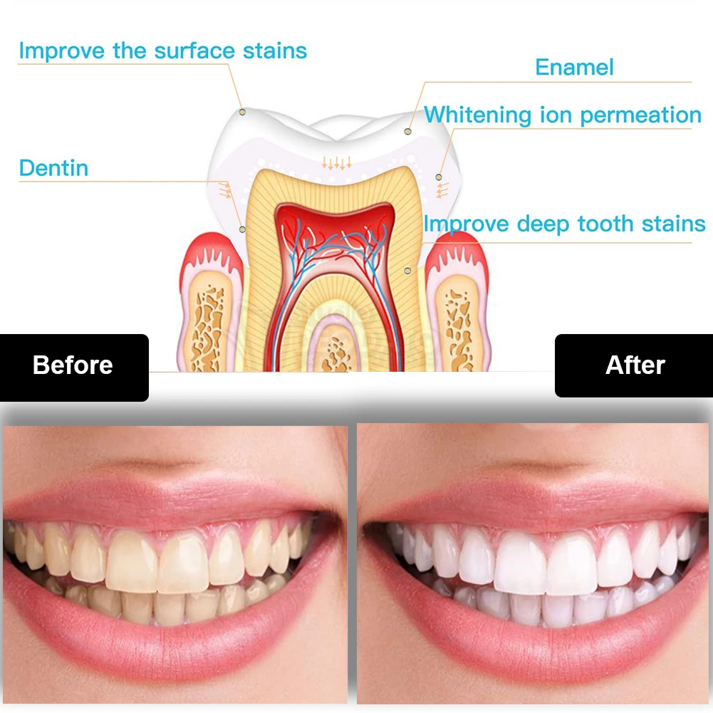 Kit de clareamento dental dos  - Teeth Whitening/Bleaching avaliação e preço