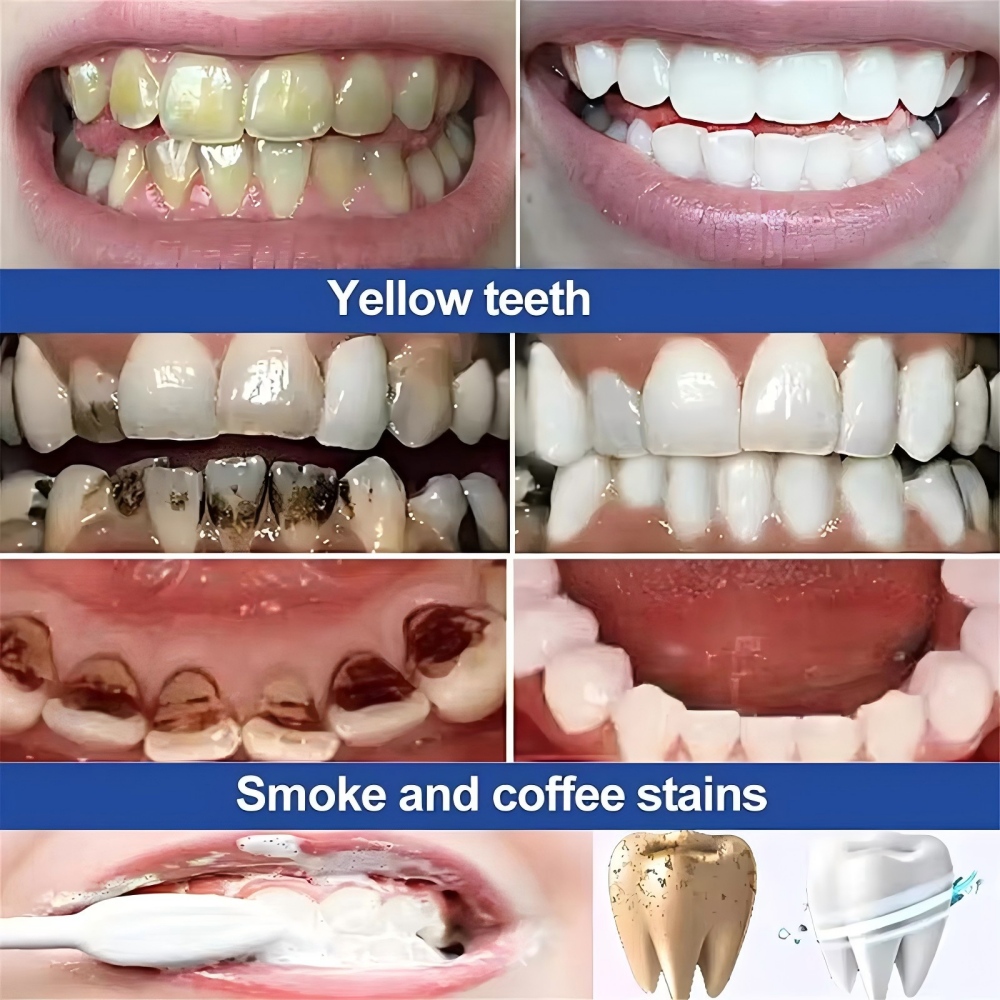 Roxo dentes branqueamento em p - Teeth Whitening/Bleaching avaliação e preço