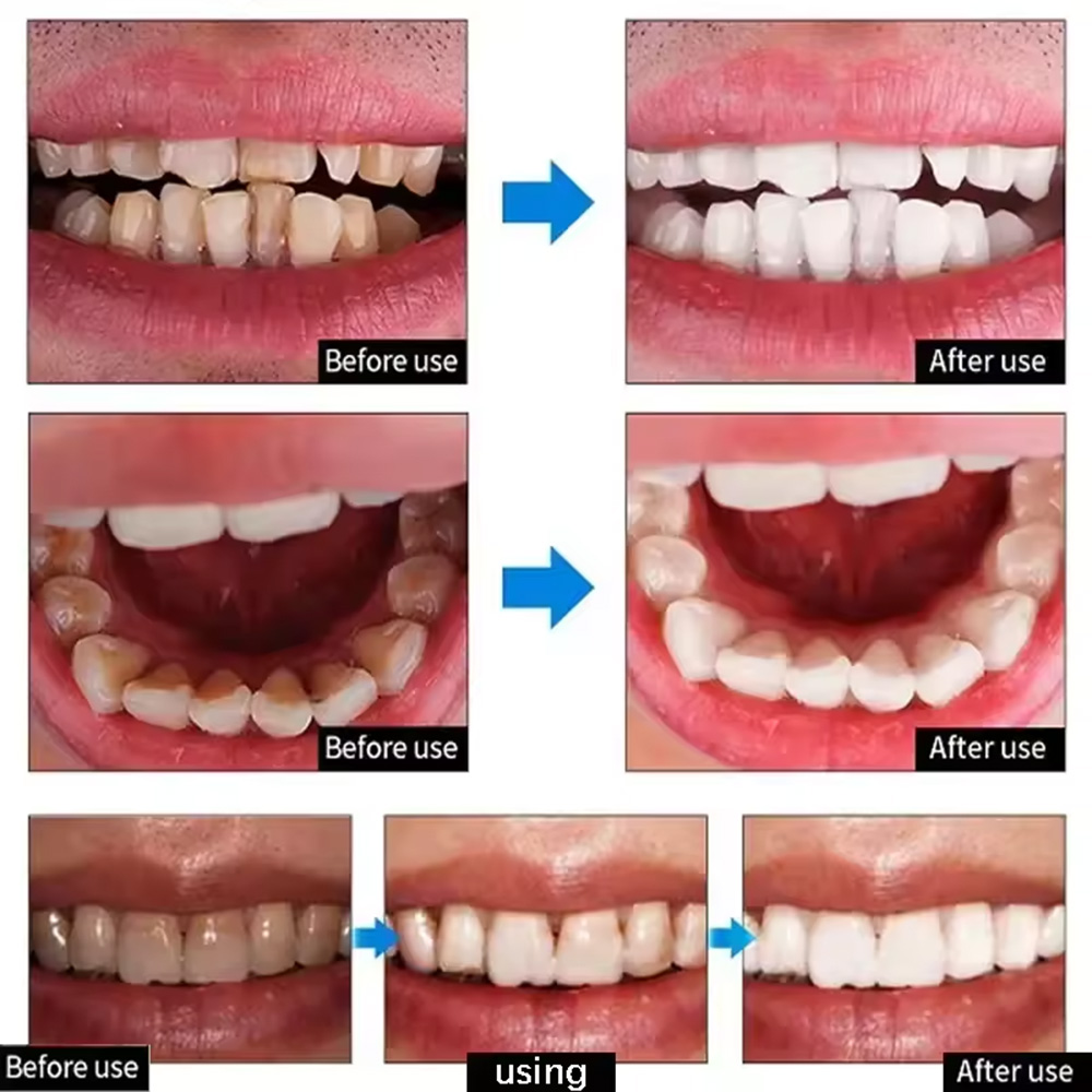 Roxo dentes branqueamento em p - Teeth Whitening/Bleaching avaliação e preço